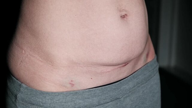 Fresh medical scars on female abdomen after laparoscopic surgery. Stretch marks on light caucasian skin after cesarean section on dark background. Body Lymphatic edema. Maternity concept. Front view.