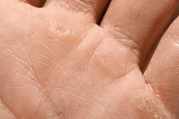 Fototapeta premium Man with dry skin on his hand, closeup
