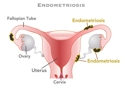 Endometriosis is a disease in which tissue similar to the lining of the uterus grows outside the uterus. Woman, female reproductive system disease. Vector illustration	