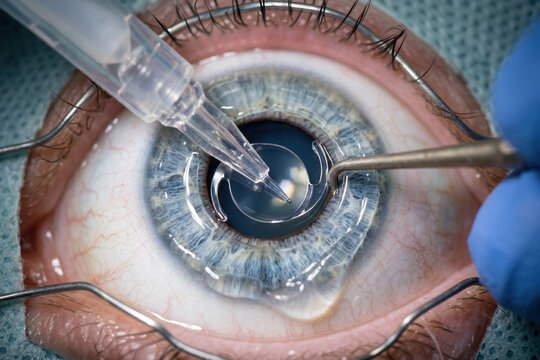 Intraocular lens implantation during cataract surgery procedure