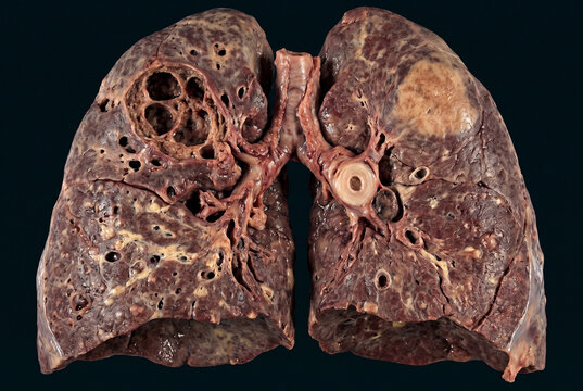 Advanced Tuberculosis Pathology Showing Cavitated Lungs