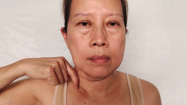portrait the fingers holding the flabbiness adipose sagging skin under the neck,neck wattle and cellulite, swelling and ptosis, forehead lines, freckles and blemish on the face,health care and beauty.