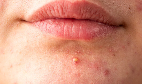 Close up epidermis with inflamed follicles and acne. Irritated skin with pimples acne texture. Macro shot of skin irritation with acne. Detailed skin with acne.