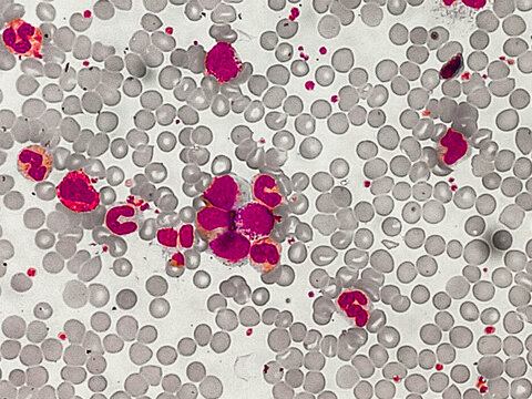 Features suggestive of Chronic Myeloid Leukaemia (Chronic phase). Microscopic image of blood cells. 