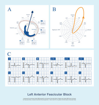 In the presence of left anterior fascicular block, the region of the left posterior fascicle is activated first, followed by the region of the left anterior fascicle; the overall activation potential 