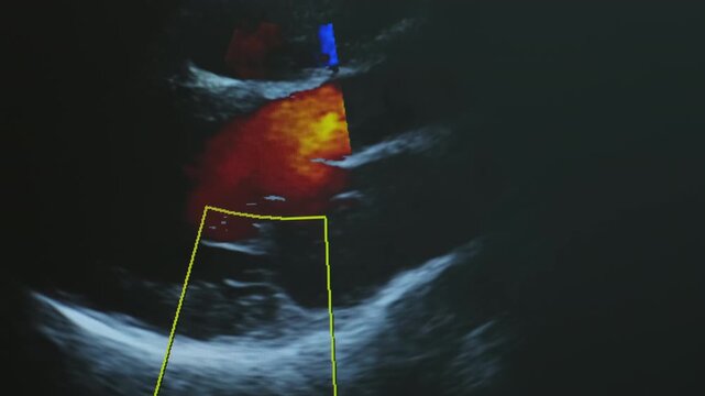 Ultrasound image of heart appears on monitor. Cardiac ultrasound on screen shows moving chambers and valves accompanied by regular heartbeat sound