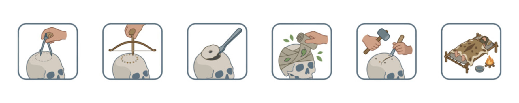 Illustration of ancient trepanation surgical procedure steps on a skull