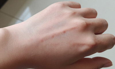 Naklejka premium detailed photograph individual hand visible signs skin disease lit soft natural