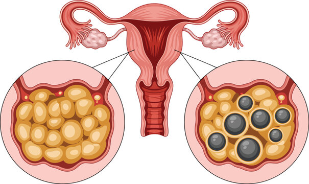 Uterus and ovaries with fibroids illustration