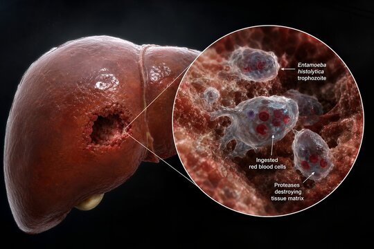 Medical illustration showing entamoeba histolytica trophozoites invading liver tissue, causing an amebic abscess, representing parasitic liver disease