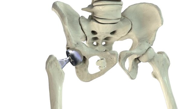 Bipolar hemiarthroplasty, 3D animation showing prosthetic femoral head replacement with dual mobility articulation within the native acetabulum of the hip joint.