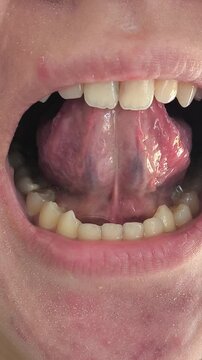 Tongue frenulum in the open mouth of a woman. Short tongue tie in adolescents, orthodontics.