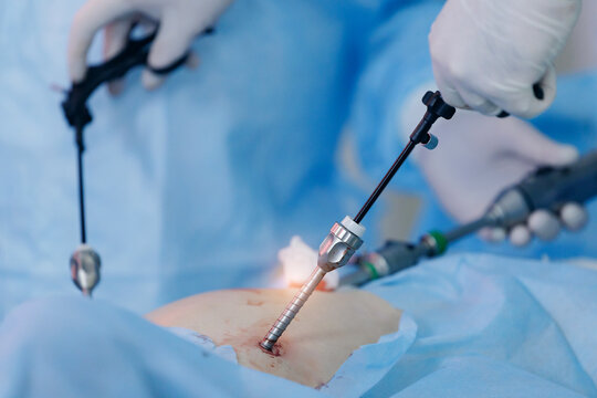 Surgeons manipulating laparoscopic tools through abdominal ports