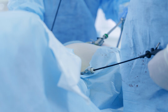 Laparoscopic instruments inserted during abdominal surgery in or