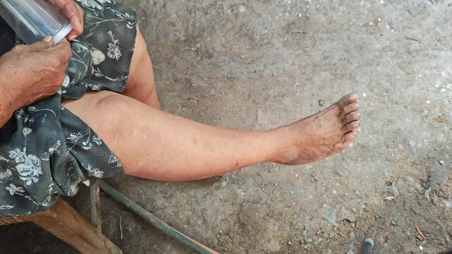 Person stretching leg to receive bee sting therapy (Apitherapy)