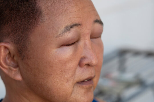 Close up portrait of a middle aged Asian man with severe facial swelling and puffy eyes caused by allergic reaction from hair dye exposure and chemical sensitivity.