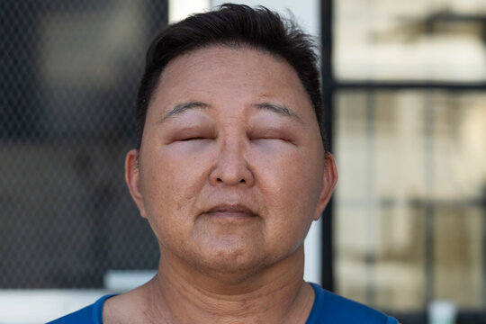 Close up portrait of a middle aged Asian man with severe facial swelling and almost closed-up eyes caused by allergic reaction from hair dye exposure and chemical sensitivity.
