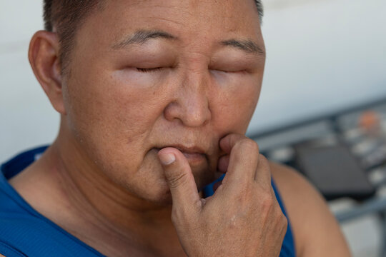 Close up of a middle aged asian man scratching his severely swollen face after a dangerous allergic reaction to hair dye chemicals causing irritation and discomfort. Eyes are nearly shut from swelling