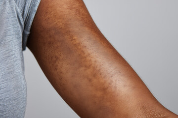 Fototapeta premium Close up of dark toned elbow skin with natural texture, visible pores, hair follicles and hyperpigmentation creating realistic dermatology study