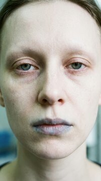 Iron deficiency anemia, a serious medical condition, presenting symptoms of pale skin, cyanotic lips, an important iron (Fe) blood disorder, showing signs of poor oxygenation