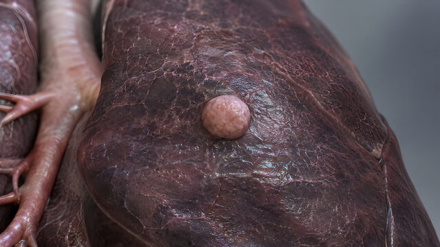 Photorealistic 3D Human Lung Solitary Pulmonary Nodule, Medical Anatomy Render, Pleural Texture, Bronchial Detail, Clinical Background, 4K Educational
