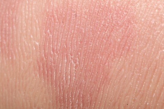 Macro view of skin with birthmark as background
