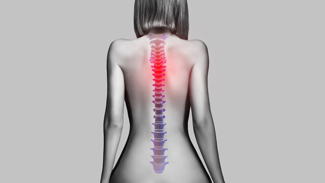 Naked back of a woman with inflamed spine, isolated on grey background