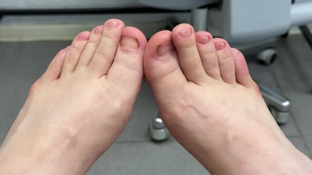 Post pedicure close-up feet showing trimmed toenails and saw noff fungal nail plates, salon chair and tiled floor in background