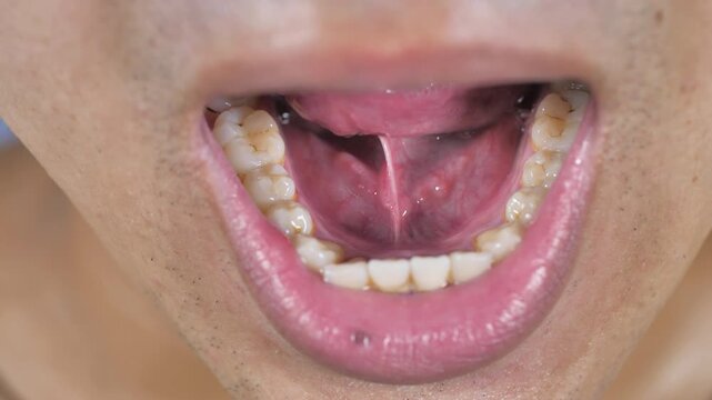 Yellow teeth, periodontitis, dental disease
