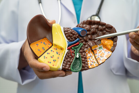 Cirrhosis, Liver cancer, fatty liver, Asian doctor with liver human model.