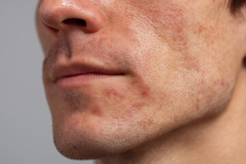 Naklejka premium Facial Allergic Rash
