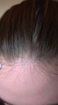 Close up view of woman hairline with visible dandruff and dry scalp flakes. Concept of scalp problems, hair care, dermatology, beauty treatment and personal hygiene.