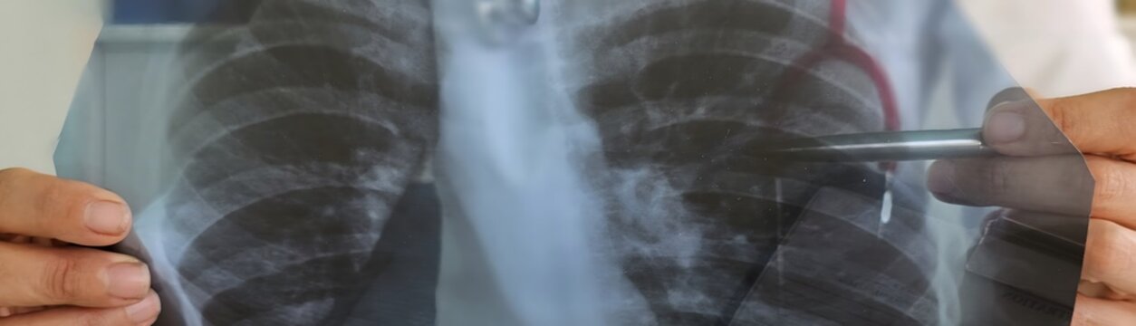 A doctor carefully examines a chest X-ray to assess the condition of the lungs and pneumonia