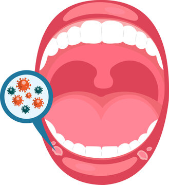 Mouth Infection Illustration