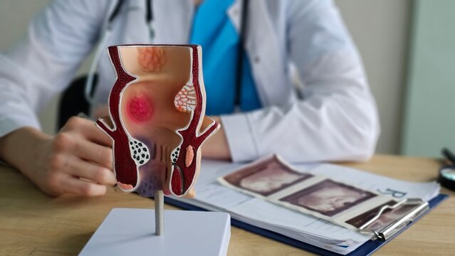 Proctologist with a model of human rectal anatomy and hemorrhoids in a hospital, inflamed vascular structure