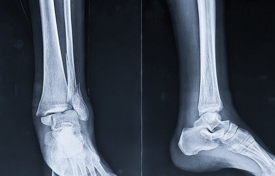 AP and lateral radiograph views displaying a displaced fracture of the distal fibula at the ankle joint.