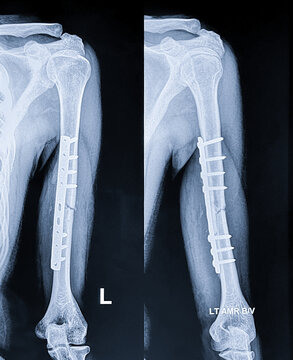Diagnostic X-ray showing surgical repair of a broken upper arm bone using a metal orthopedic plate and screws.