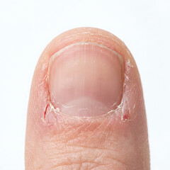 Fototapeta premium Close-up of human thumb with damaged nail and dry skin 