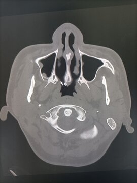 CT scan of the paranasal sinuses in an axial section, showing fluid in the right maxillary sinus