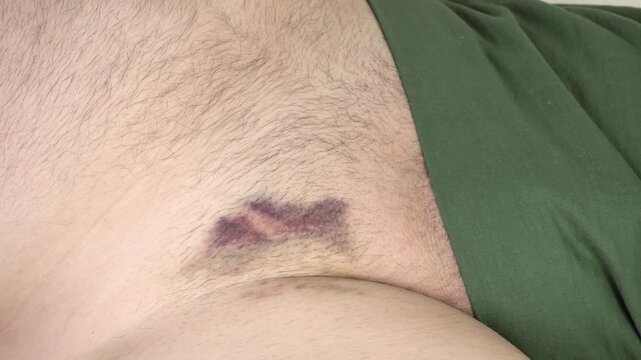 A close-up view shows significant subcutaneous blood leaks on the inner thigh after the stent insertion procedure. Ideal scene for medical education, cardiology training, or healthcare documentaries.