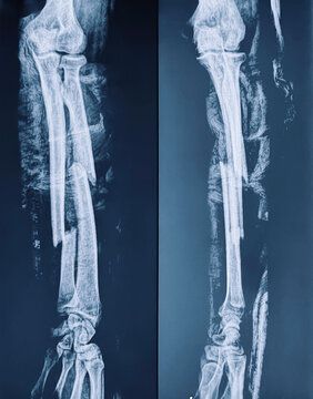 AP and lateral radiograph displaying displaced mid-shaft fractures of the radius and ulna within a cast.