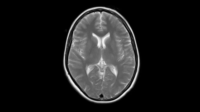 Axial brain MRI slices displayed sequentially as a continuous 3D animation, detailed neuroanatomy visualised through layered cross-sections, clinical radiology concept.