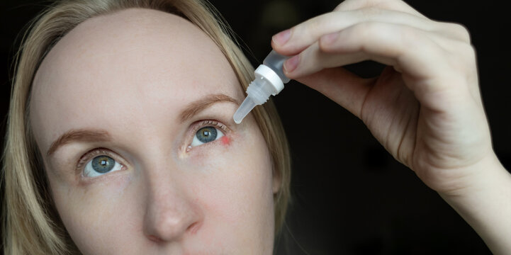 Close-up of a woman applying medical drops to treat a red eye stye or chalazion on the lower eyelid. Healthcare, ophthalmology and infection treatment concept.