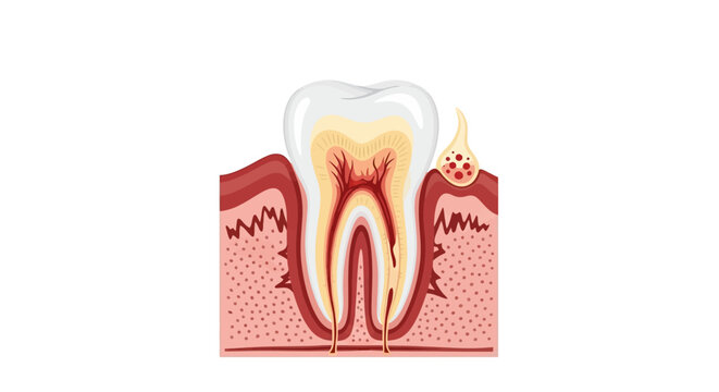 Anatomy of a tooth with abscess.