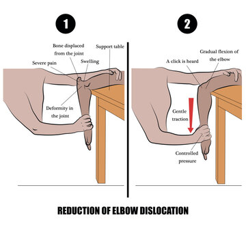 Elbow Dislocation Reduction &ndash; Orthopedic Emergency Procedure.