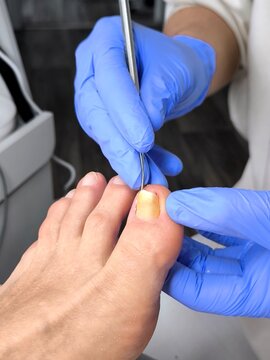 A master podologist treats an ingrown toenail on the big toe.