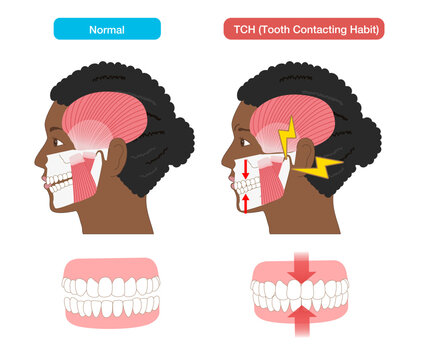 Illustration comparing TCH (Tooth Contacting Habit) and normal teeth viewed from the side
