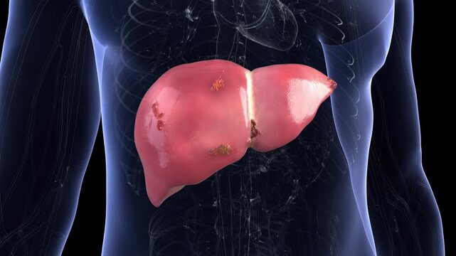 Liver cysts multiply and spread across a healthy organ, causing cirrhosis, hepatitis, and cancerous lesions. 3D animation visualizing progressive hepatic deterioration.
