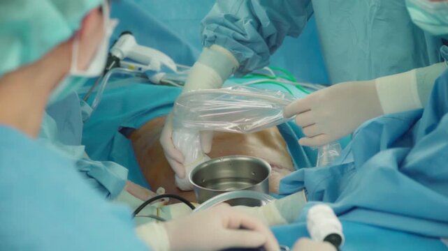 Laparoscopic cholecystectomy instrument. The surgeon's doing laparoscopic gastric sleeve surgery