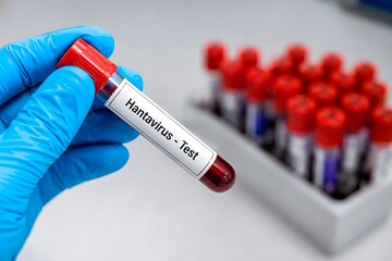 Fototapeta premium Hand holding hantavirus test tube with blood sample